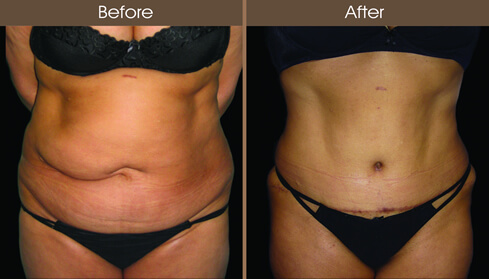 20122210155626_abdom_12_front